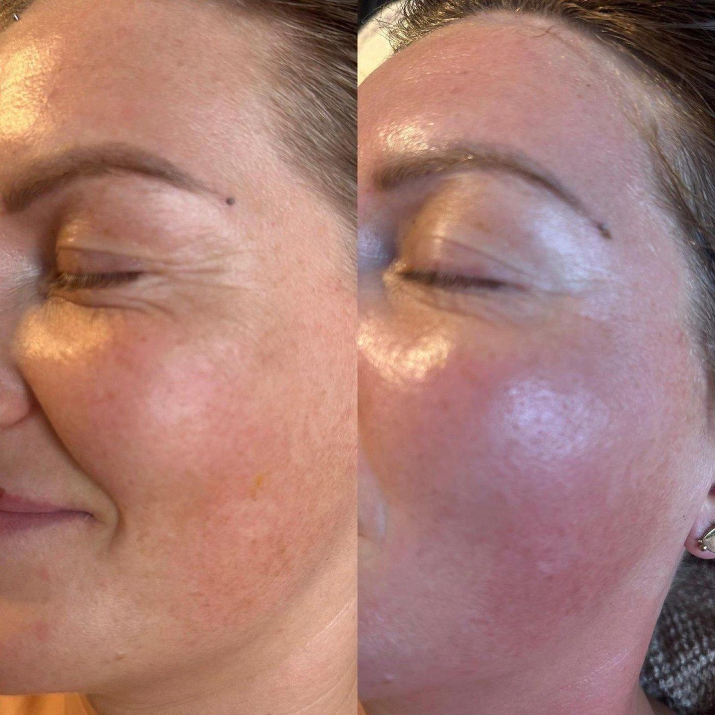 Exosome Microneedling