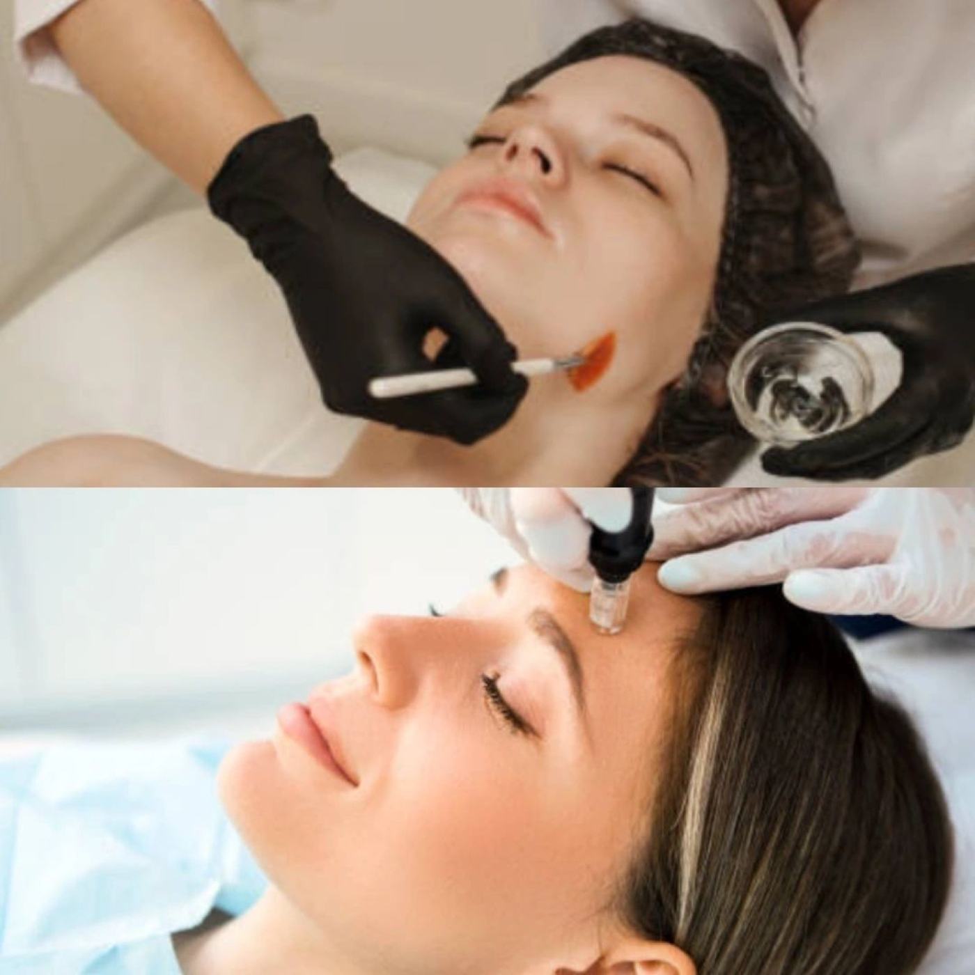 Kombi-Behandlung aus CO₂-Maske und Microneedling