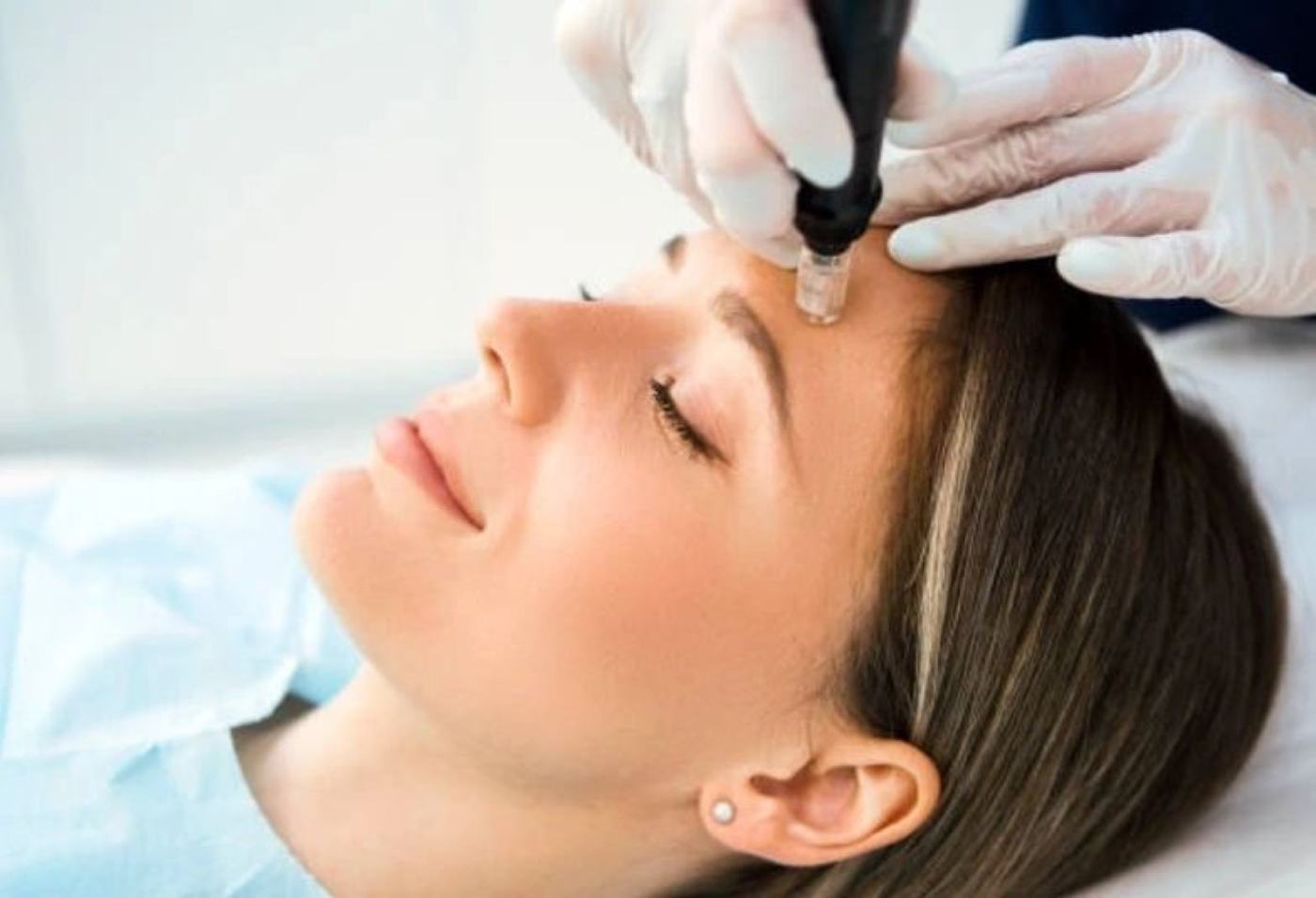 Frau erhält Microneedling im Gesicht