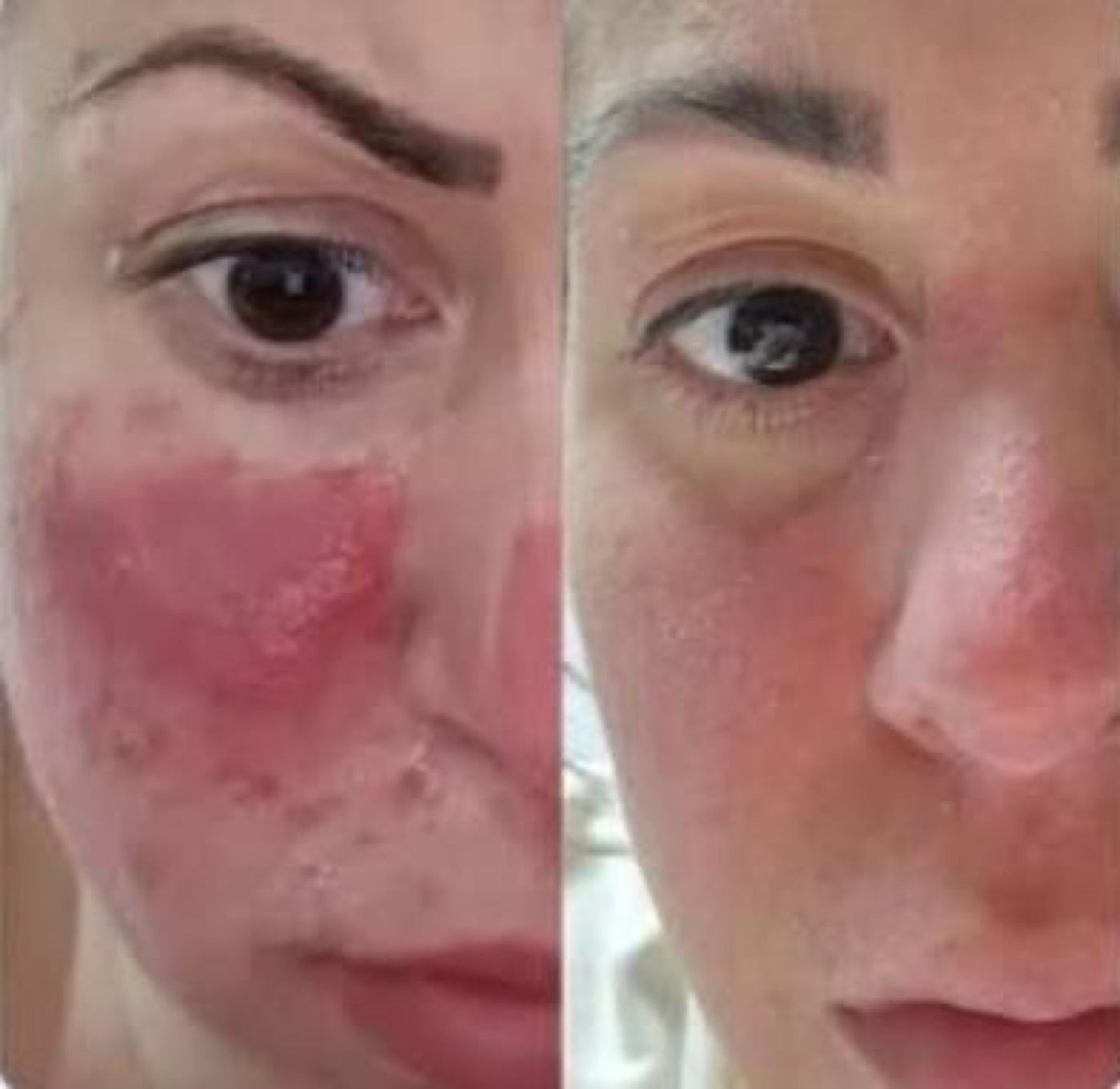 Rosacea- und Couperose-Behandlung